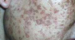 汗孔角化症患者在生活中